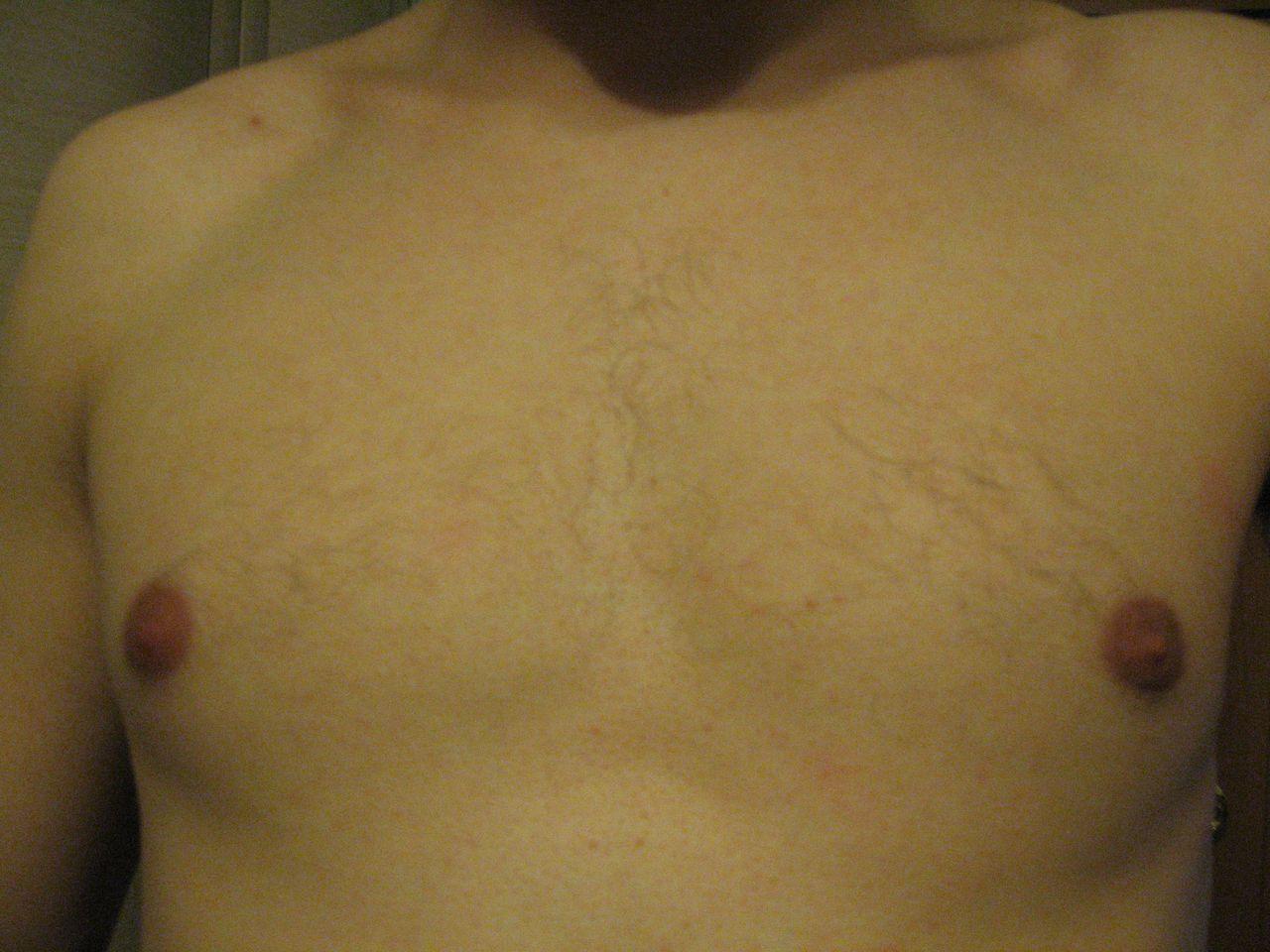красное уплотнение на груди у мужчин фото 44